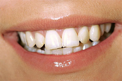 4 способи зробити зуби білішіми